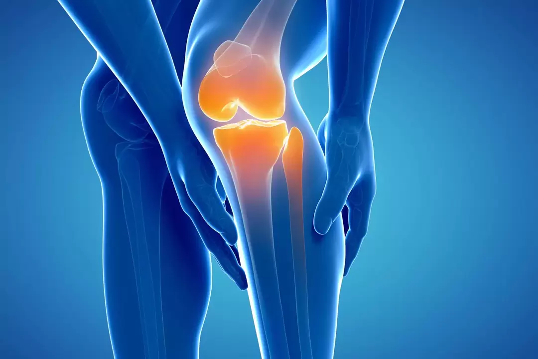 Arthrose de l'articulation du genou (gonarthrose, arthrose déformante)