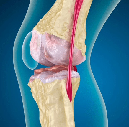 Arthrosose de l'articulation du genou