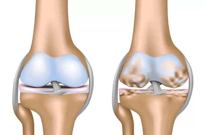 Déformation de l'arthrose de l'articulation du genou