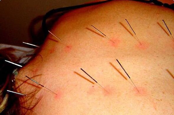 Acupuncture – une méthode de traitement de l’ostéochondrose cervicale