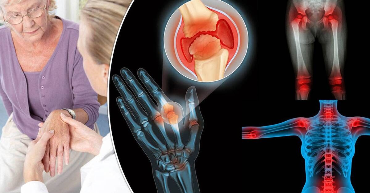 Qu’est-ce que l’arthrose 